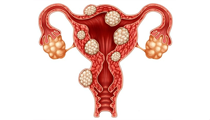 Ce este fibromul uterin? Cauze, simptome și tratament